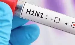 Swine Flu : राजनांदगांव में स्वाइन फ्लू की दस्तक, मेडिकल कॉलेज में 10 बेड का अलग वार्ड तैयार